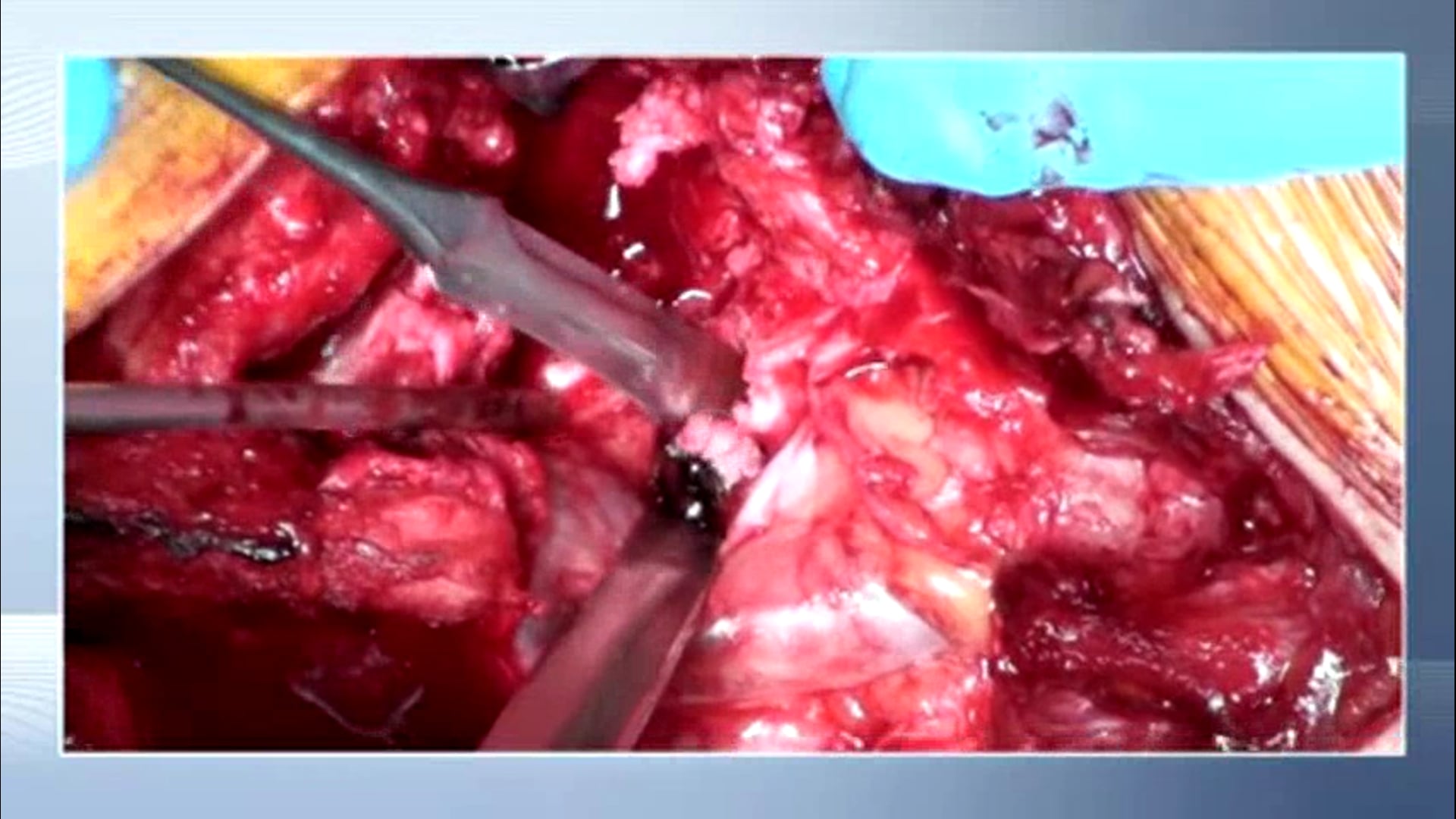 Posterior instrumentation, reduction and fusion in spondyloptosis
