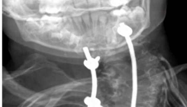 Surgery of a Klippel-Feil malformation of the cervicothoracic junction