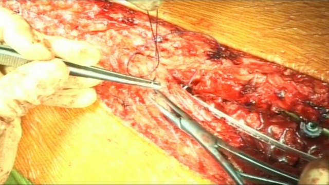 Posterior surgery in Scheuermann's ky...