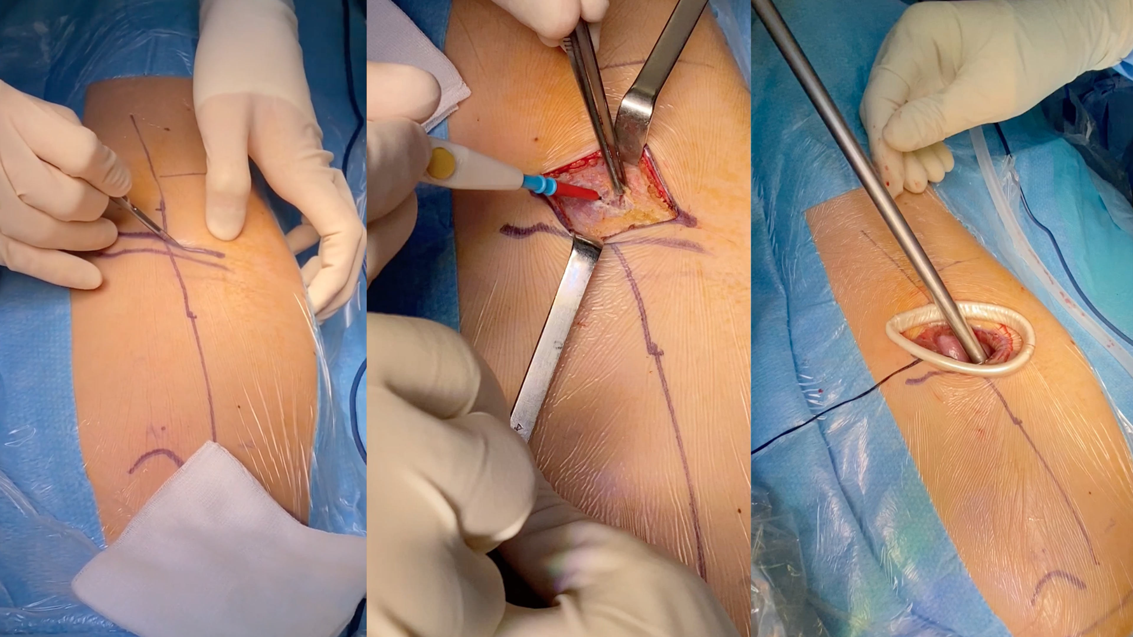 Vertebral Body Tethering (VBT) in the treatment of adolescent idiopathic...