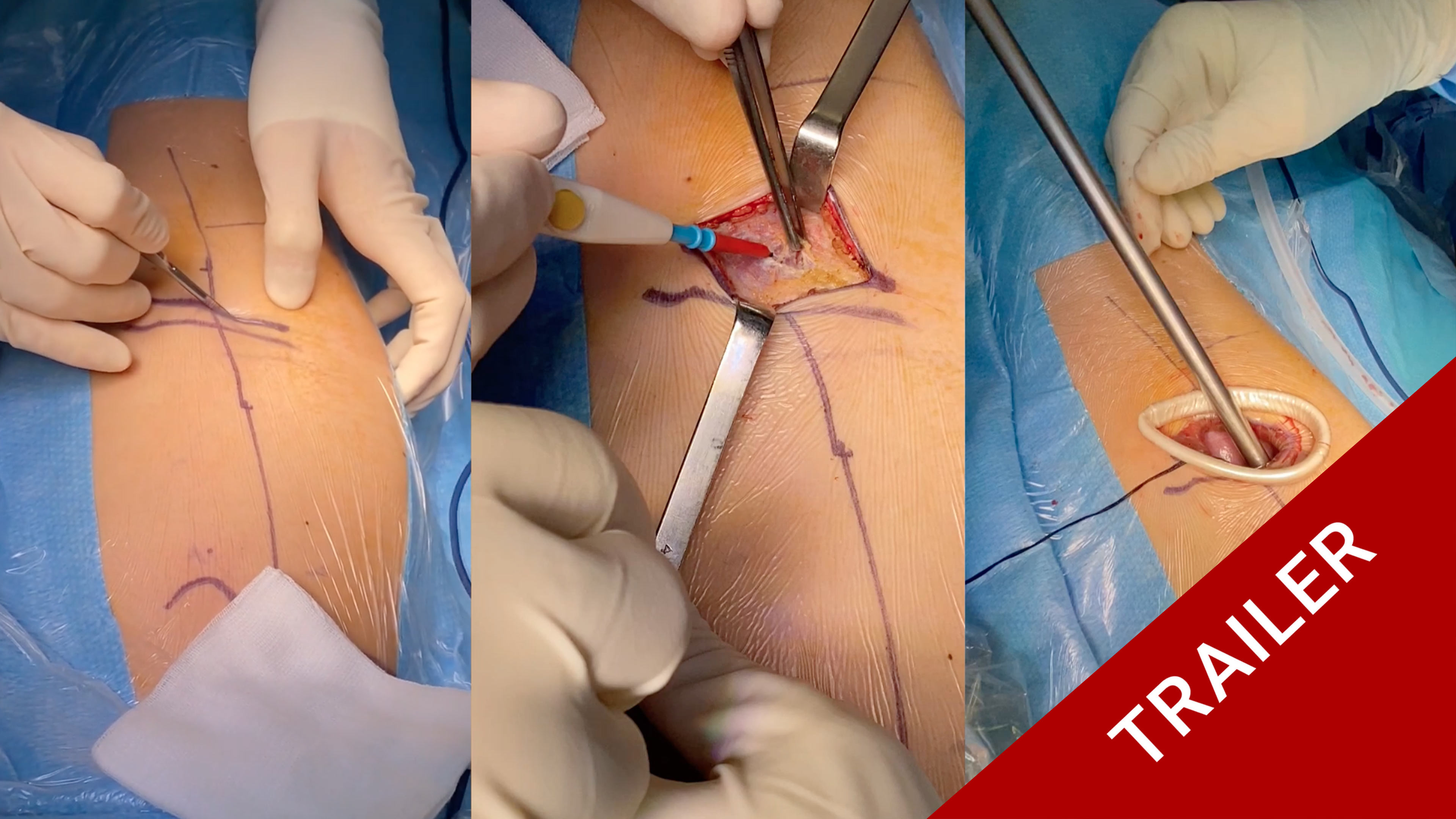 Trailer Vertebral Body Tethering (VBT) in the treatment of AIS