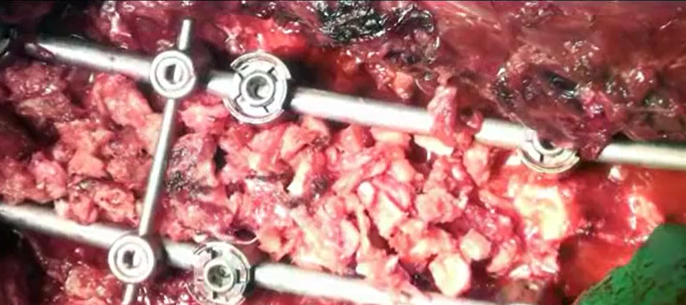 Adult de novo lumbar scoliosis.........