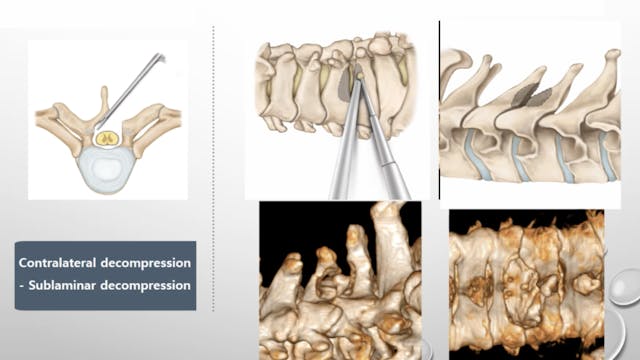 Posterior cervical laminectomy by uni...