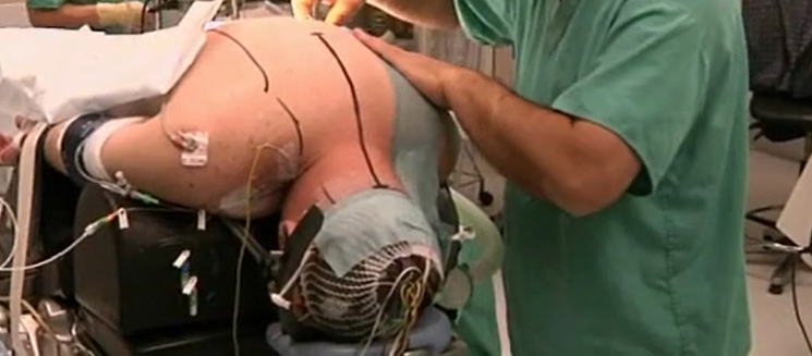 Cervical osteotomy in ankylosing spondylitis