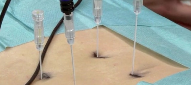 Radiofrequency facet joint denervation in the lumbar spine