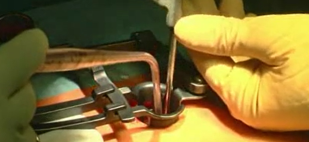 Microdiscectomy for recurrent L5-S1 disc herniation