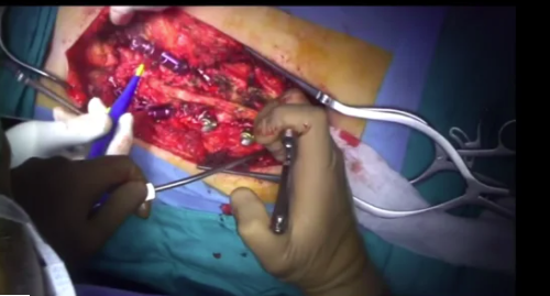 Surgical management of iatrogenic kyphosis