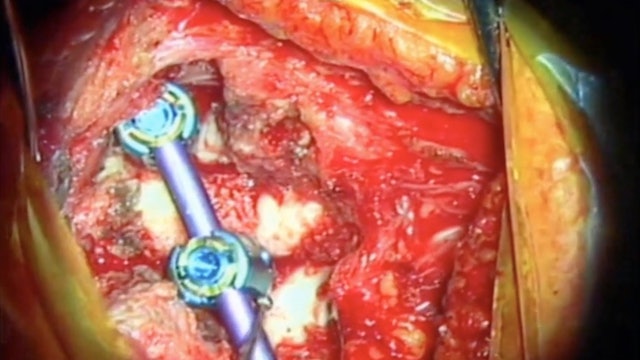 Trailer Computer navigation guided excision of cervical osteoblastoma