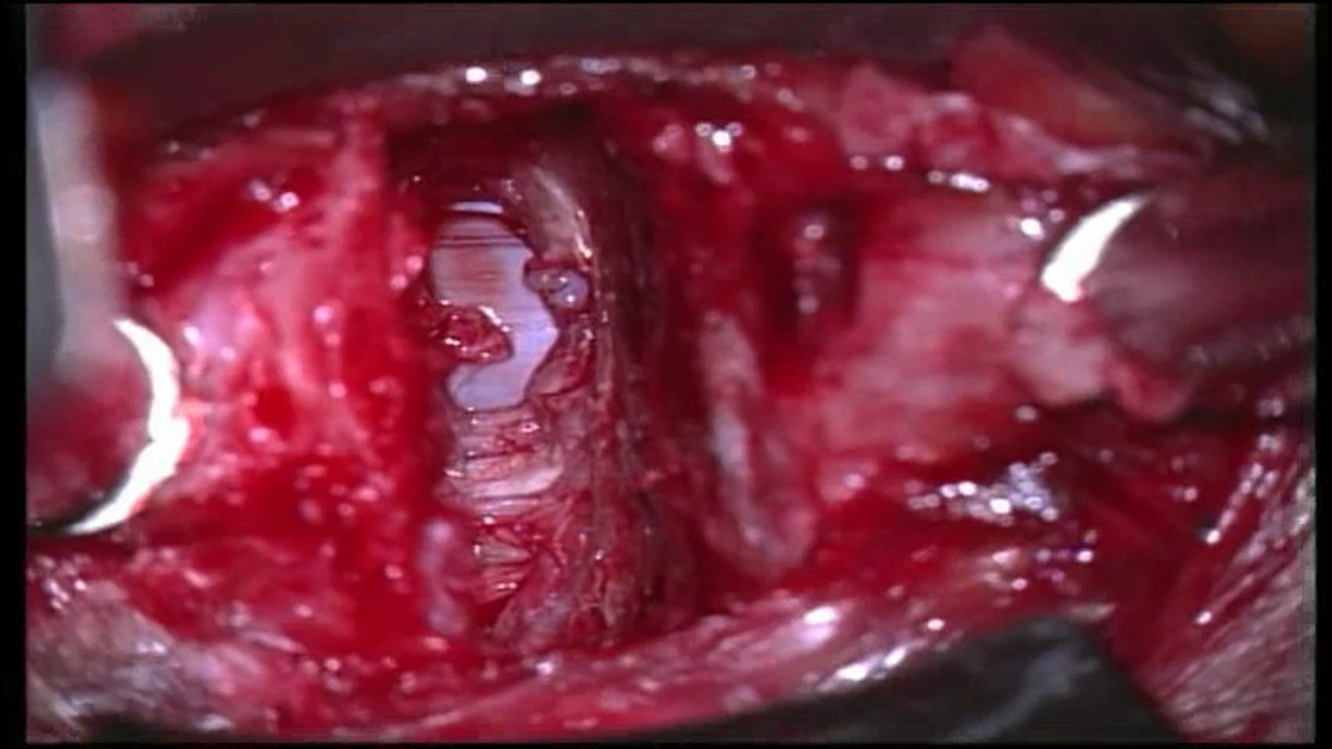 Cervical total disc replacement C5/6