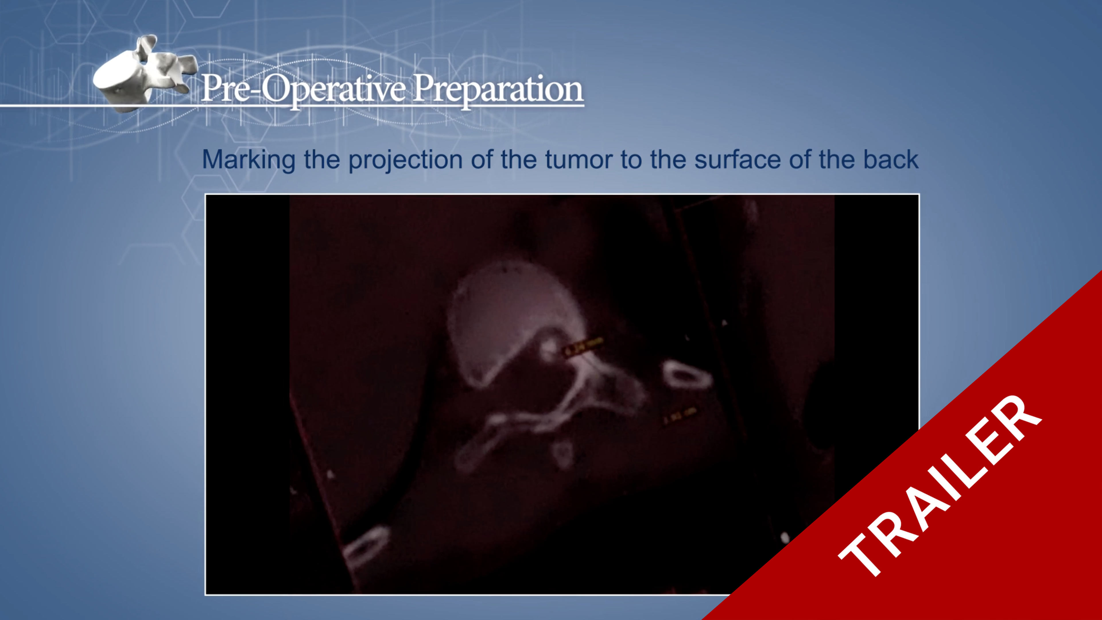 Trailer Osteoid Osteoma of Th10 vertebra (Transition Pedicle-Vertebral Body L)