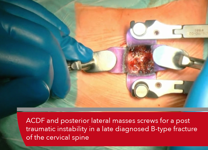 Trailer ACDF and posterior lateral masses screws for a post traumatic...