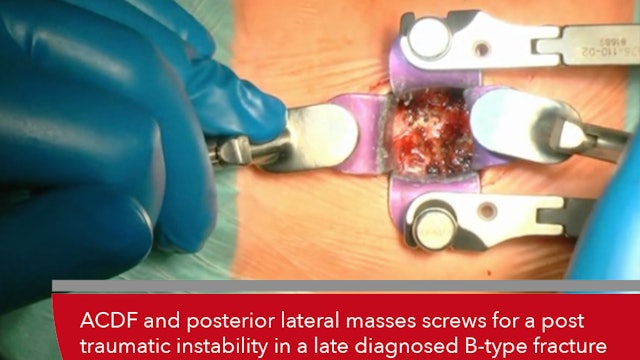 Teaser ACDF and posterior lateral masses screws for a post traumatic...