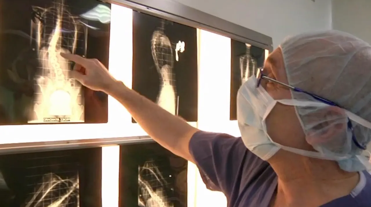 Trailer Selective thoracolumbar instrumentation in adolescent ...