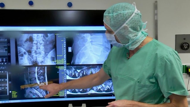 Technique of a fully endoscopic lumbar discectomy via an interlaminar approach