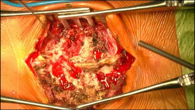 Trailer Thoracic hemivertebra resection by posterior approach for congenita...