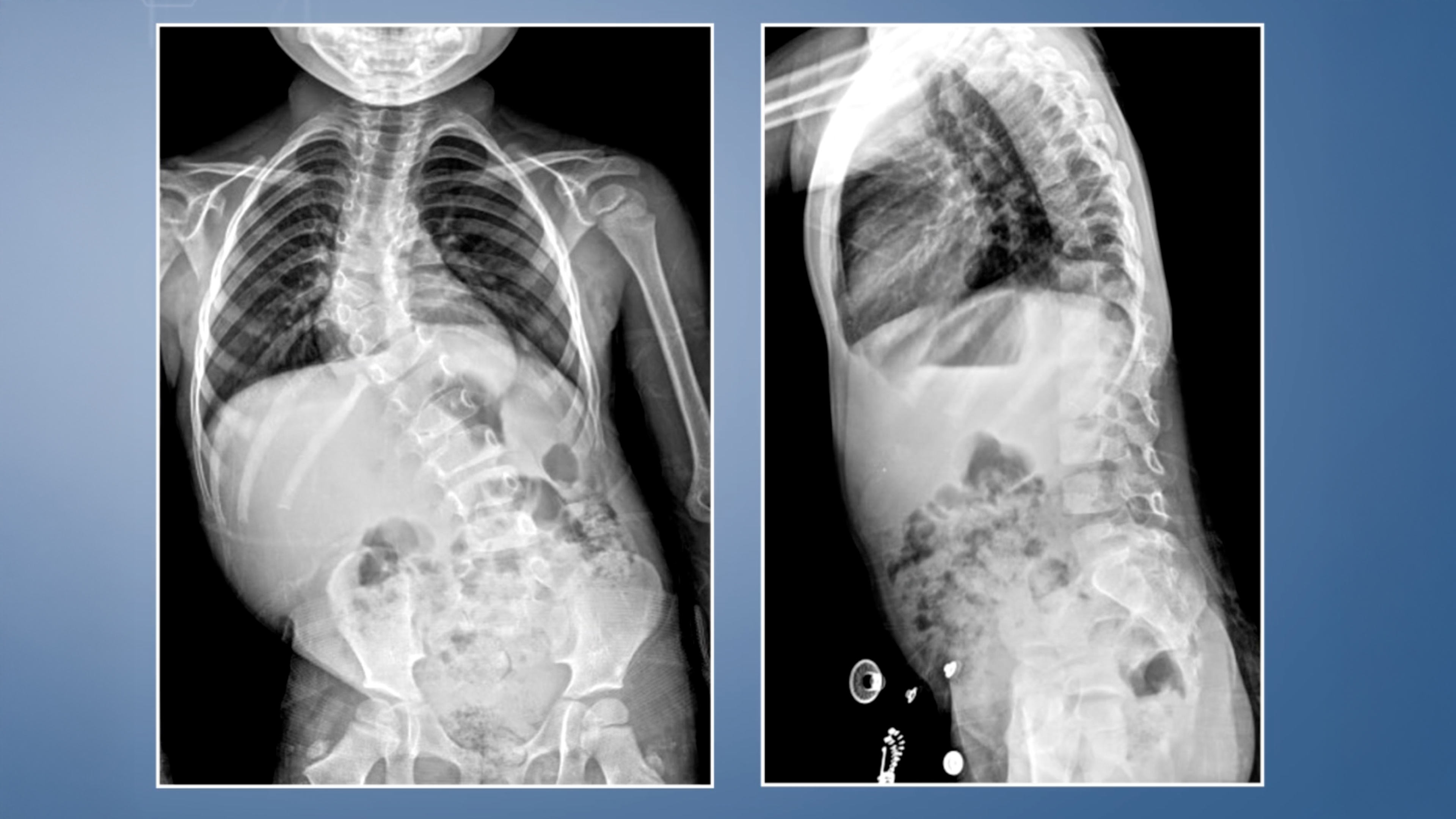Resection of Thoracic Hemivertebra in Congenital Scoliosis