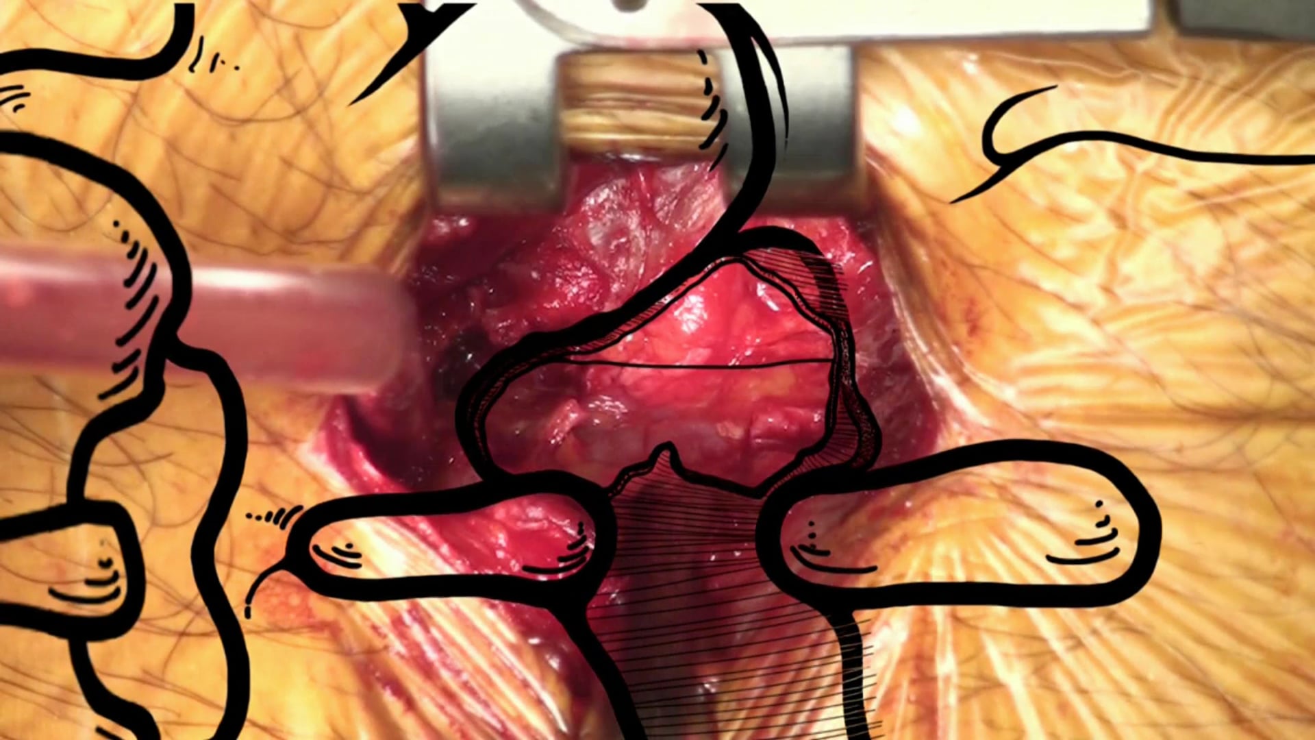 Surgical tricks for open lumbar discectomy