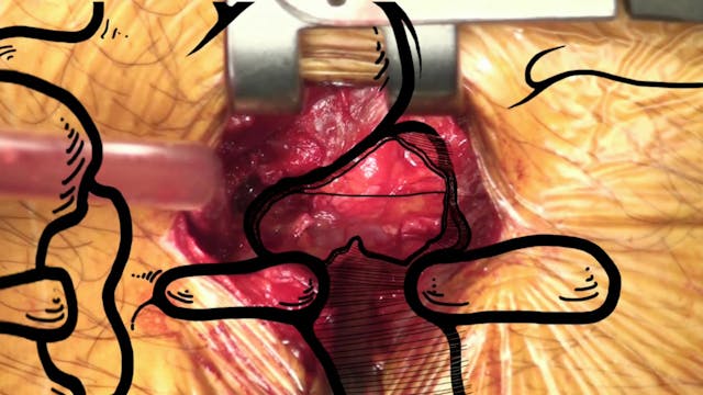 Surgical tricks for open lumbar disce...