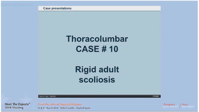 Rigid adult scoliosis; case presentations