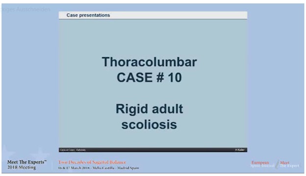 Rigid adult scoliosis; case presentations