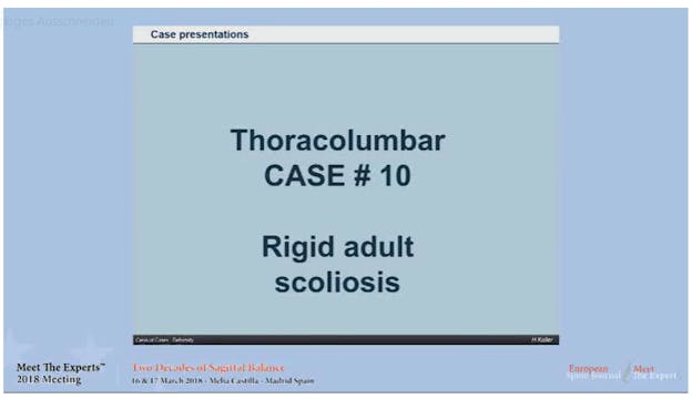Rigid adult scoliosis; case presentat...