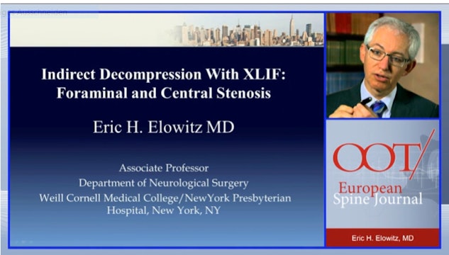 Indirect decompression with XLIF: Foraminal and central stenosis