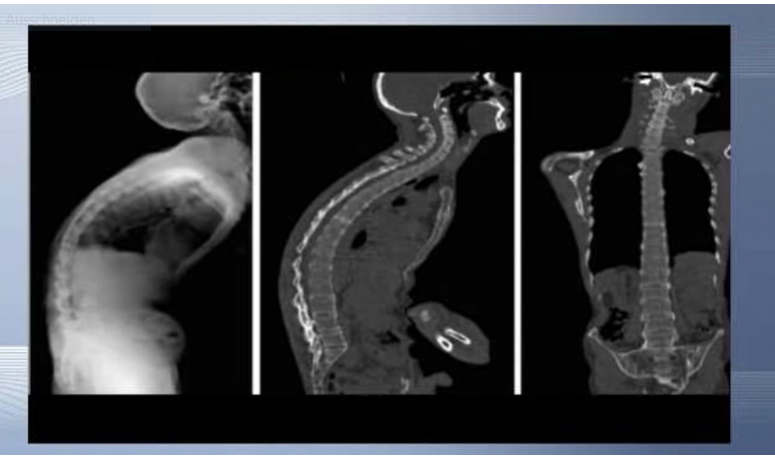Ankylosing spondylitis neural and sparing osteotomy