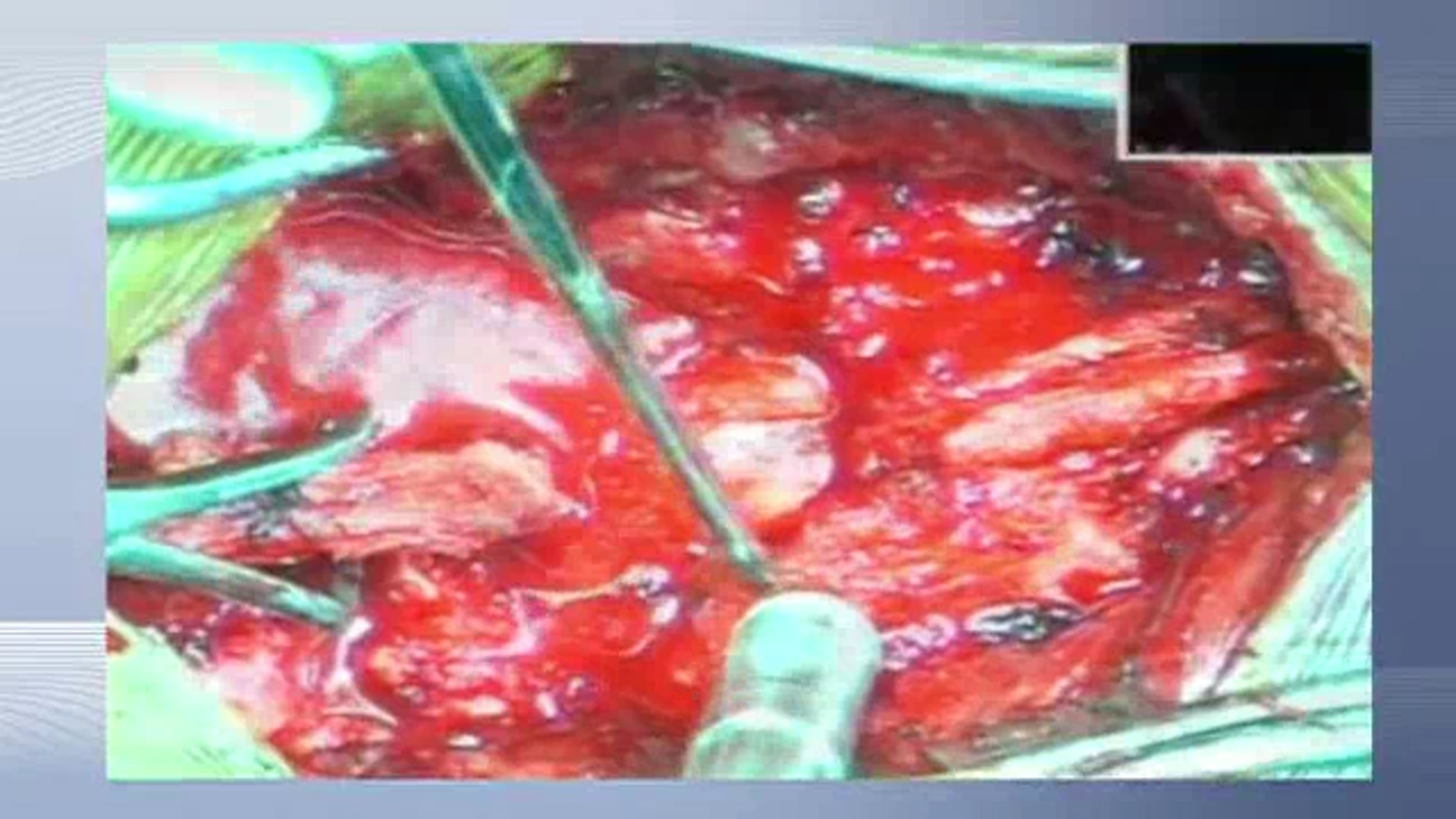 Reduction of high grade listhesis