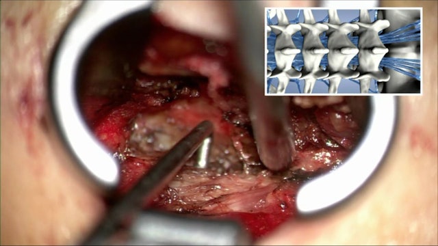 Lumbar sequestrectomy via a translaminar approach