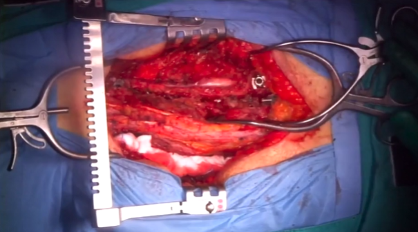 Kickstand rod technique for correction of coronal imbalance