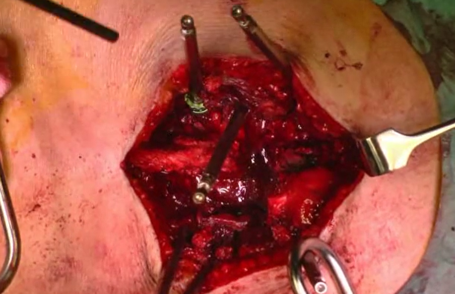 Transition anomalies at the lumbosacral junctions