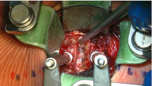 Anterior cervical decompression and 360° fusion with posterior pedicle screws...