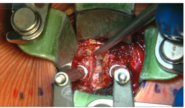 Anterior cervical decompression and 360° fusion with posterior pedicle screws...