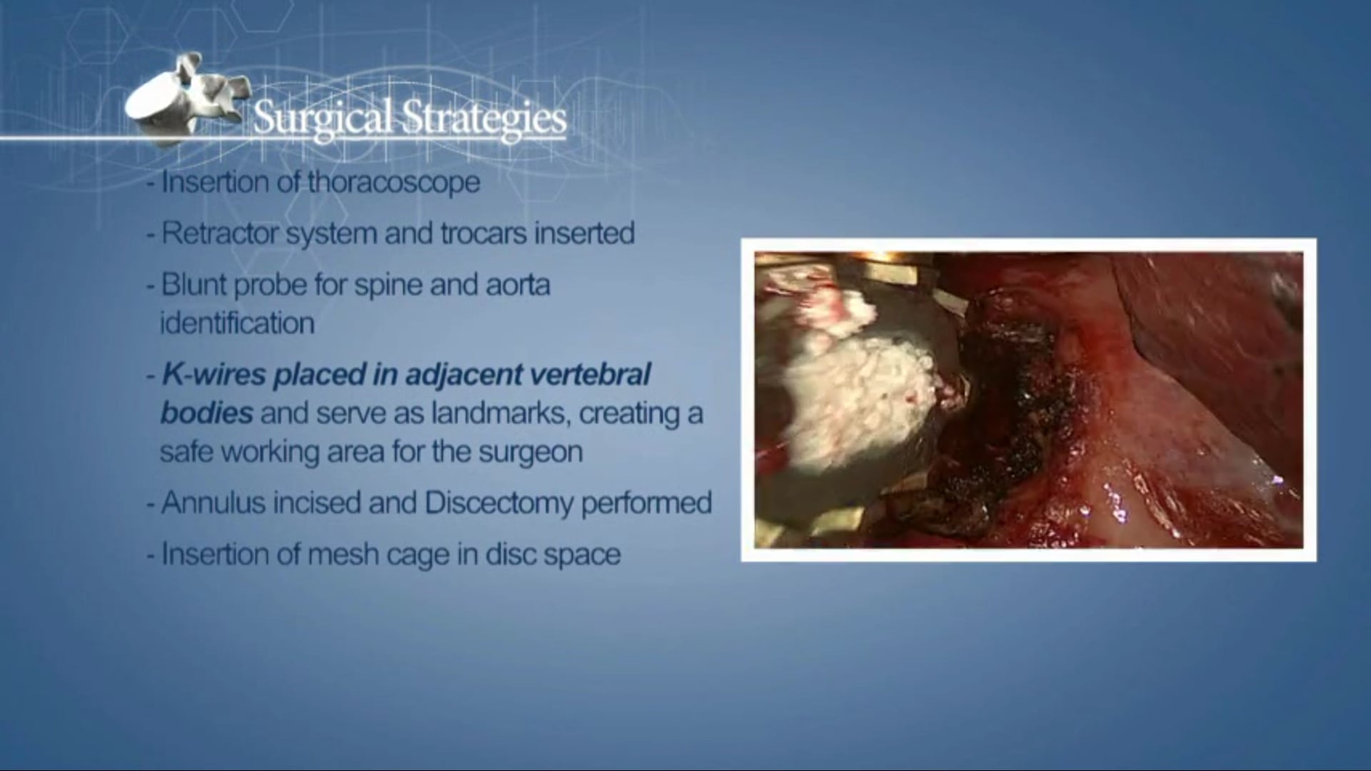 Thorascopic technique of anterior discectomy and interbody fusion (ATIF)