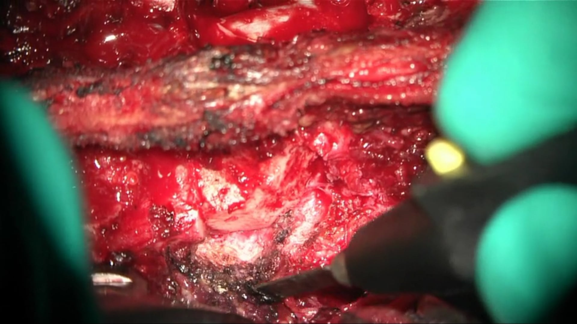 Open spinal instrumentation with posterior only approach to open wedge osteotomy