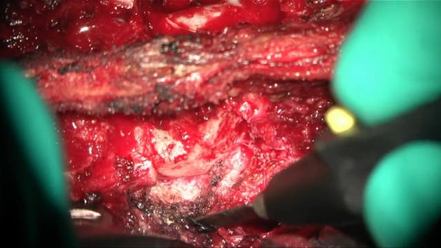 Open spinal instrumentation with post...