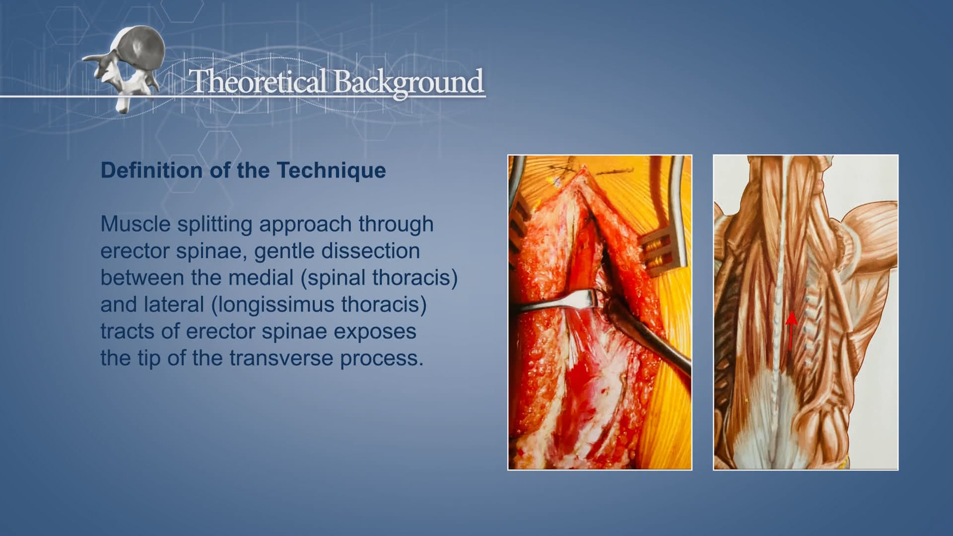 Less invasive instrumentation and correction in paediatric deformity