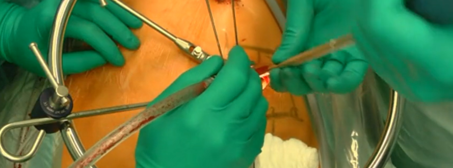 Correction of a mobile posttraumatic kyphosis...........