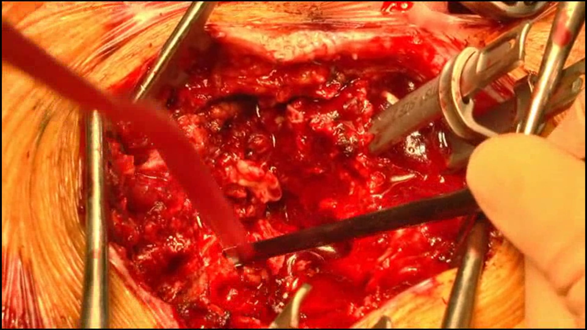 Mini open tumor resection and percutaneous instr. for T11 renal cell carcinoma