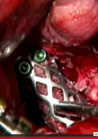 Single stage total endolesional C2 spondylectomy for chordoma