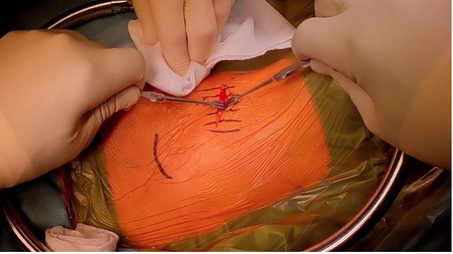 Anterior decompression and fixation with a stand-alone cage