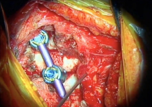 Computer navigation guided excision of cervical osteoblastoma