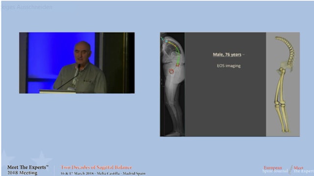 Sagittal balance; case presentation