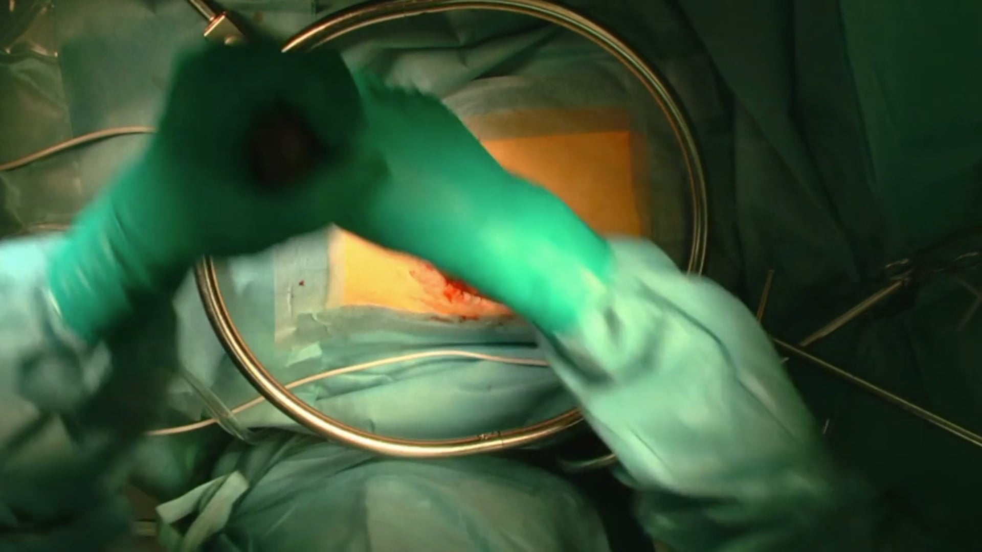 Trailer Vertebral body replacement in the thoracolumbar spine via mini-open