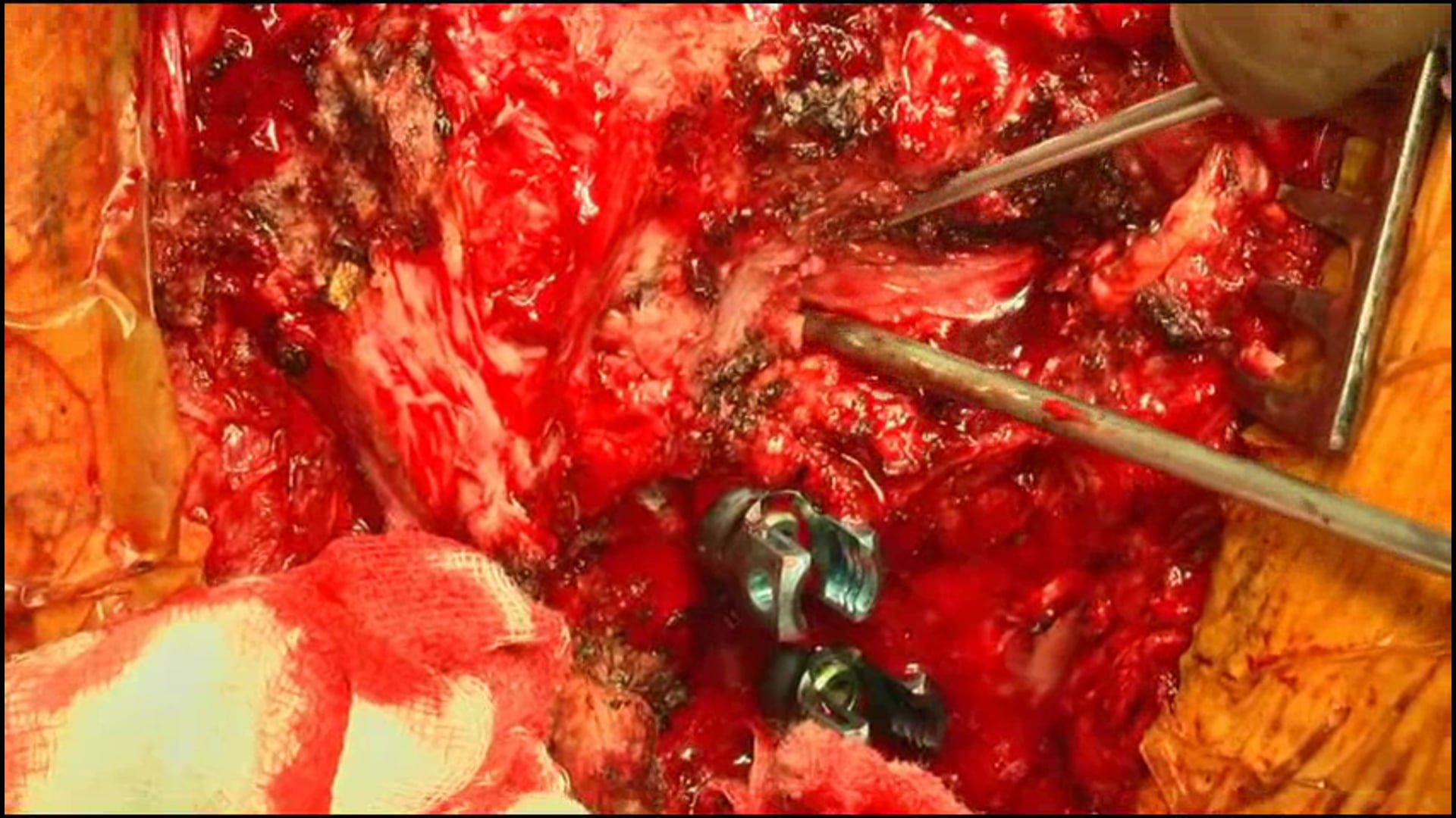 Asymmnetric T5 PSO for complex posttraumatic deformity