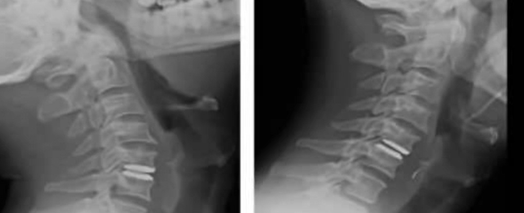 Cervical disc replacement C5-6