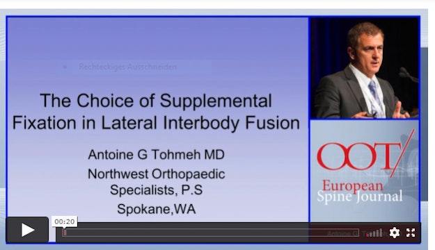 The choice of supplemental fixation in lateral interbody fusion