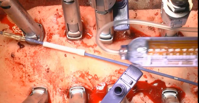 Percutaneous, cementaugmented reposition and stabilization of burst fractures