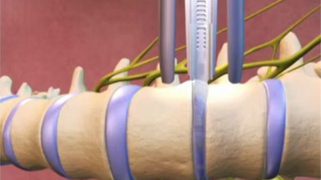 Trailer Minimally invasive lateral transpsoas approach for lumbar interbody..