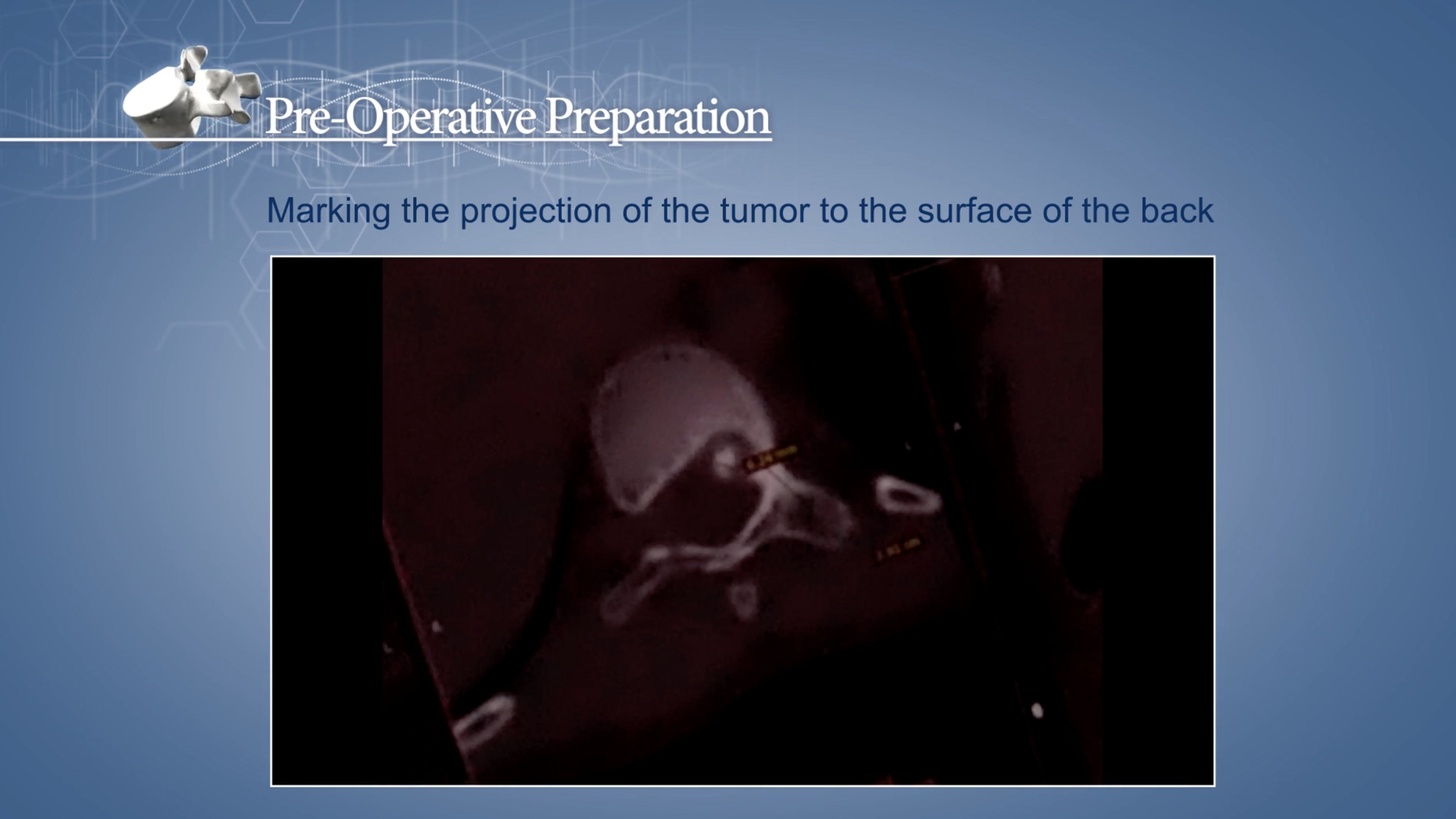 Osteoid Osteoma of Th 10 vertebra (Transition Pedicle - Vertebral Body L)